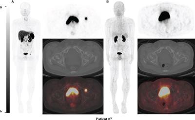 Head-to-Head Comparison of 68Ga-DOTA-TATE and 68Ga-DOTA-JR11 PET/CT in Patients With Tumor-Induced Osteomalacia: A Prospective Study